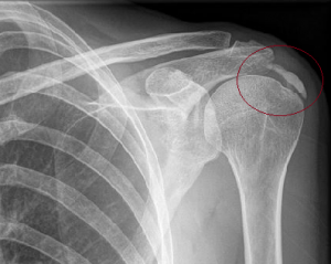 Tendinitis_calcificante_hombro