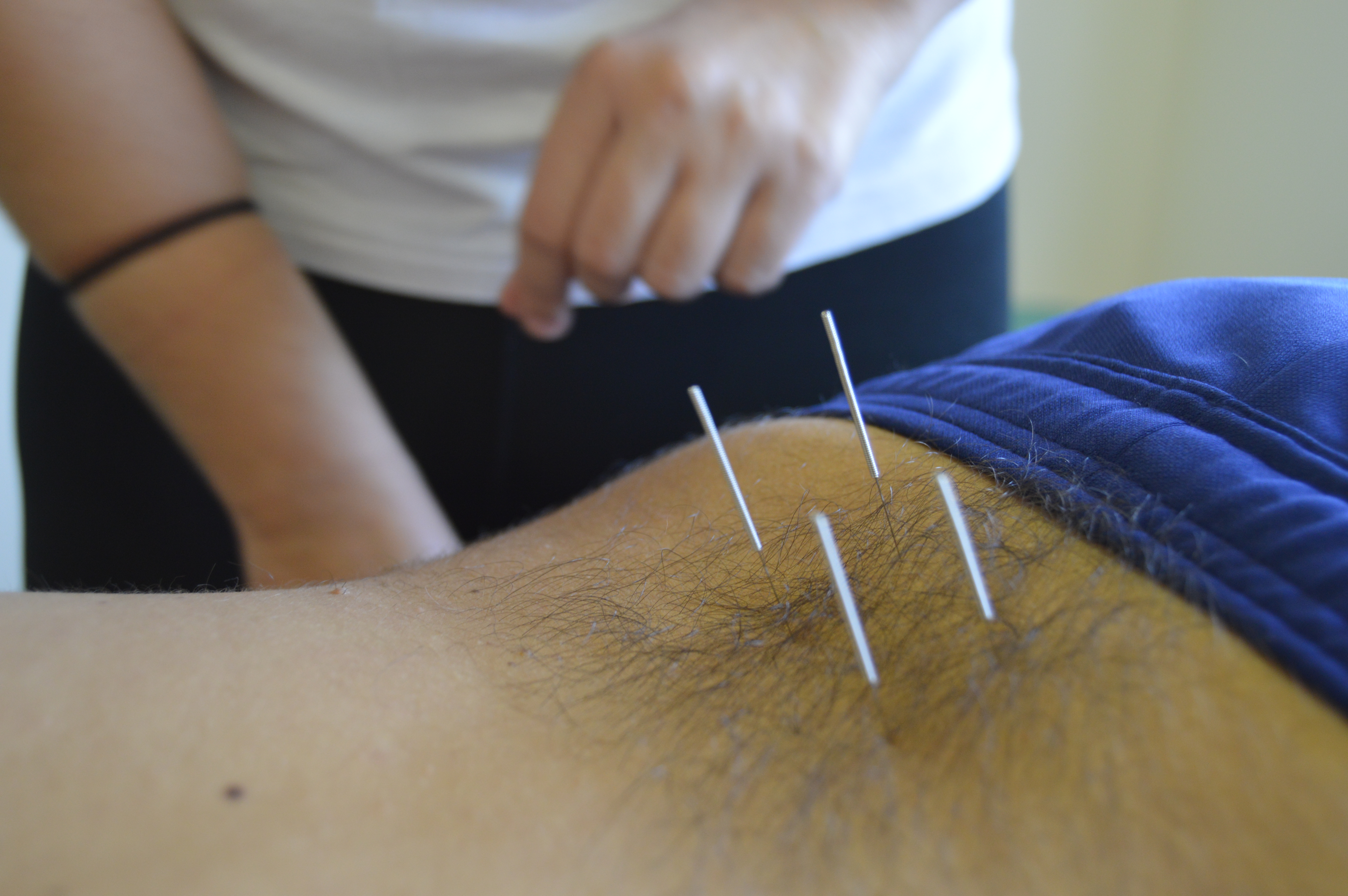 tratamiento acupuntura almeria