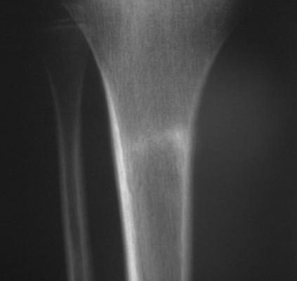 tratamiento fracturas almeria